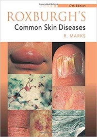 Image of Roxburgh's Common Skin Diseases